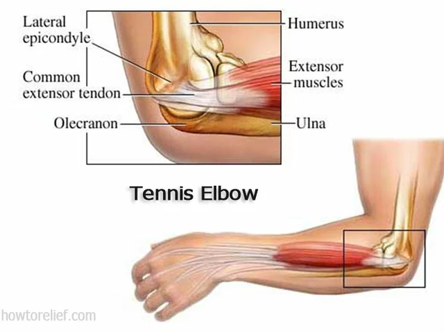 How can I quickly recover from tennis elbow?